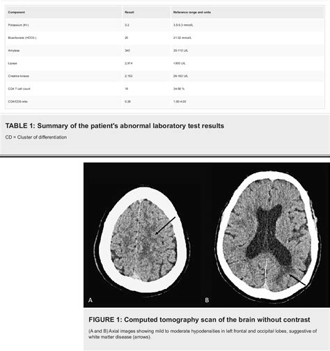 Figure 1 From Pregabalin Toxicity Induced Posterior Reversible Encephalopathy Syndrome