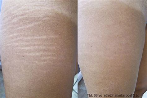 Laser Scar And Stretch Mark Removal