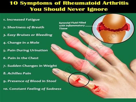 What does rheumatoid arthritis feel like in the hips? What Does A Rheumatoid Arthritis Attack Feel Like | Family ...