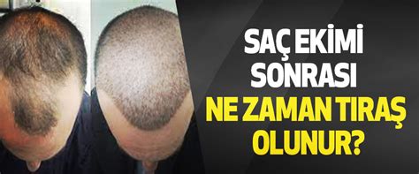 Saç Ekimi Sonrası Ne Zaman Tıraş Olunur?