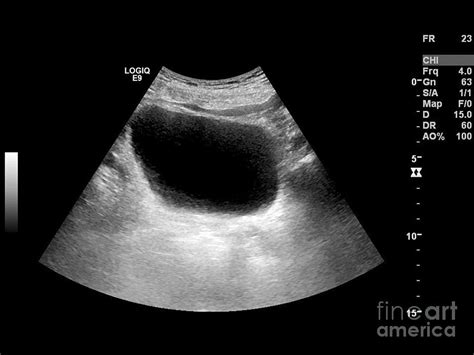 Bladder Mass Ultrasound Scan Photograph By Science Photo Library