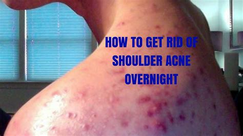 How To Get Rid Of Shoulder Acne Overnight Youtube