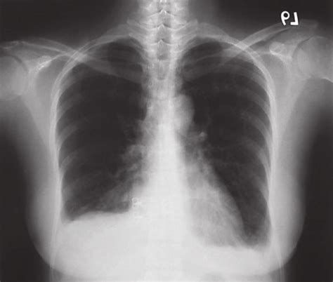 Posterior Anterior Chest Radiograph Showing Bilateral Pleural Effusions