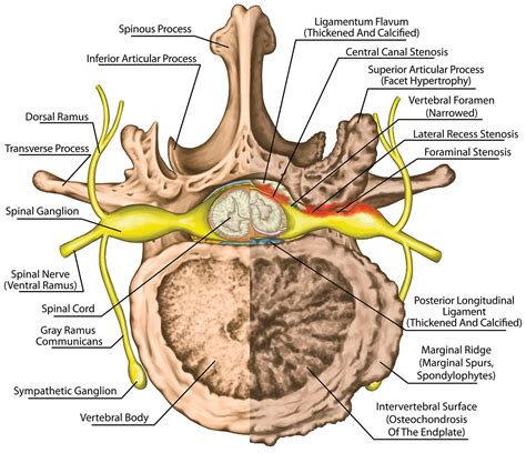Lumbar stenosis treatment without surgery