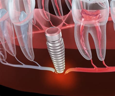 Failed Dental Implant Removal Houston Dentist Sunrise Dental Center