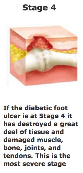 Stage 4 studios provides photo, video and cinema services to the public and business community. emDOCs.net - Emergency Medicine EducationOsteomyelitis: Making the Diagnosis - emDOCs.net ...