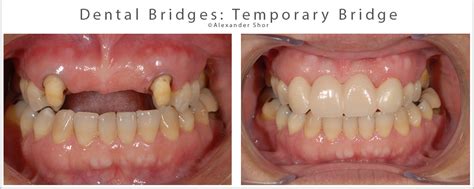 Dental Bridges By Seattle Expert Dentist Teeth Replacement Shor Dental