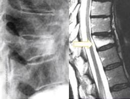 L'osteoporosi: malattia sociale | Radiologia Ortopedica
