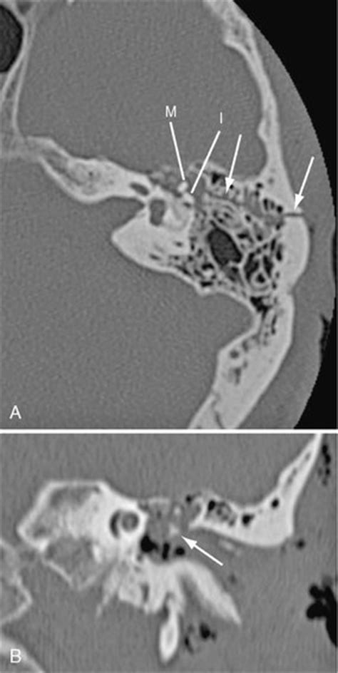 Fracture and Hemorrhage | Radiology Key