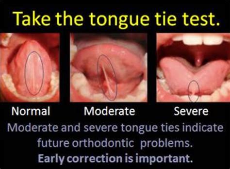 Image Result For Tongue Tie Tongue Tie Tongue Problems Tongue