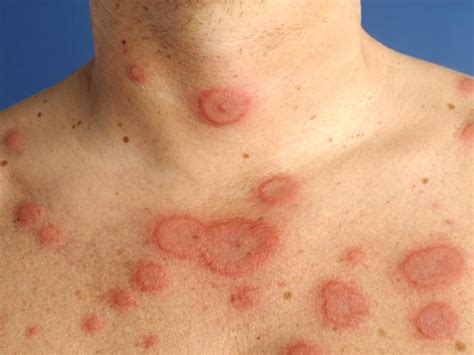 Accumulating evidence indicates that lichen sclerosus in women may be associated with other autoimmune disease, whereas this association seems to lack in male patients. Derm/Ophthalm - StudyBlue