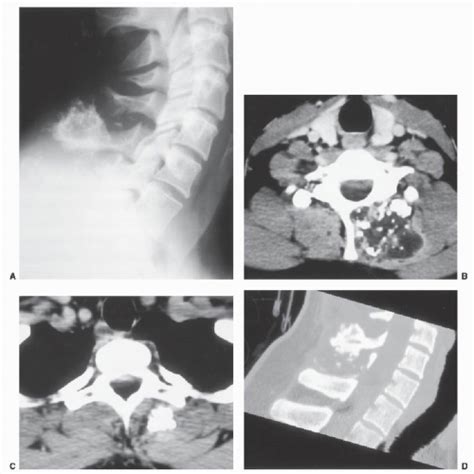 Primary Malignant Tumors Of The Cervical Spine Neupsy Key