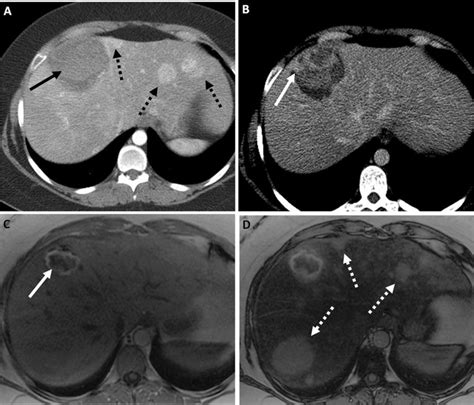 Hemorrhage Within A Hepatic Adenoma A Axial Arterial Phase