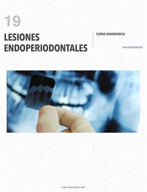 Odontocat Curso Online De Endodoncia