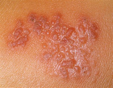 Rashes That Cause Blistering Itchy Rash Skin Rash Types Of Rashes The