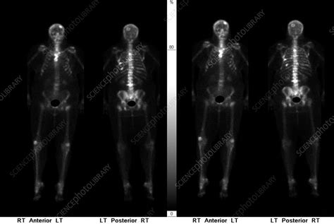 Metastatic Cancer Bone Scan Stock Image C0393321 Science Photo