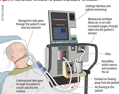 An Overview Of Mechanical Ventilation In The Intensive Care Unit