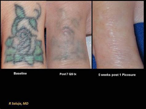 Top 71 Tattoo Removal Process Photos Super Hot Ineteachers