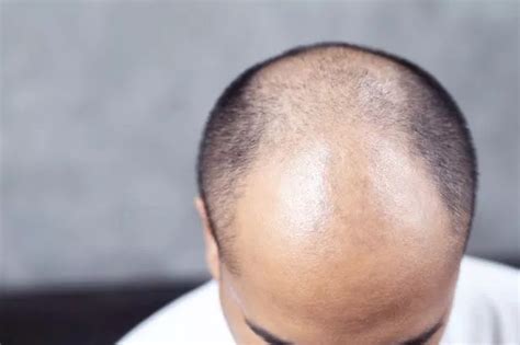 Japanese Researchers Move One Step Closer To Cure For Baldness Buzzie