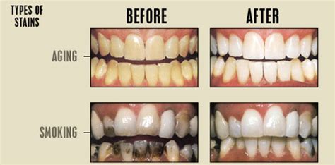 Antibiotic And Tooth Discoloration