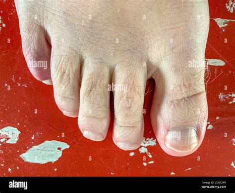 Fractured Toe High Resolution Stock Photography And Images Alamy