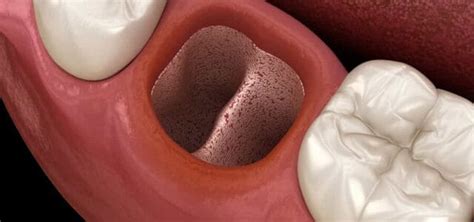 Alveolitis Dental Tipos Y Cómo Prevenir Su Aparición Ferrusandbratos