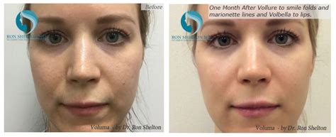 Non Surgical Midface Lift With Facial Fillers Midface Filler Nyc