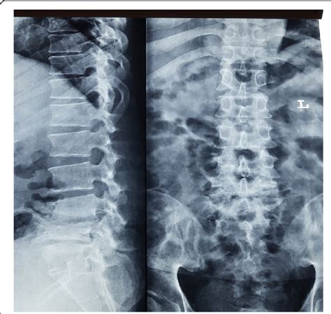 Lumbosacral Radiograph Showing Irregularities Of The L4 L5 And S1