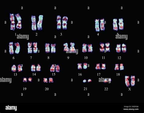 Philadelphia Chromosome Coloured Light Micrograph Of A Female