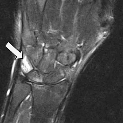 White Arrows In T Weighted MRI Appearance Of Ganglion Cyst In Wrist Download Scientific Diagram