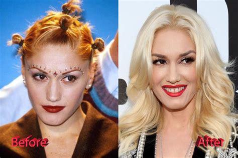 Gwen Stefani Plastic Surgery Boob Job Botox And Facelift Plastic