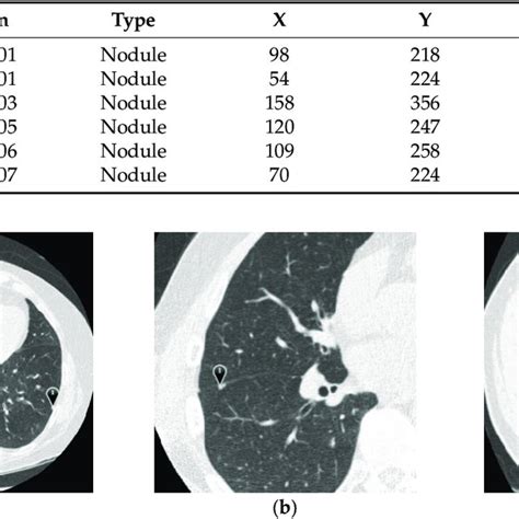 Format Of Lung Nodule Position Download Table