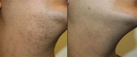 Laser Hair Removal Before And After