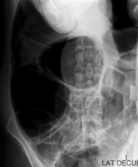 Large Bowel Obstruction Wikiradiography