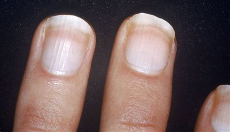 Be Careful Change In Color Of Nails Is A Sign Of These Diseases