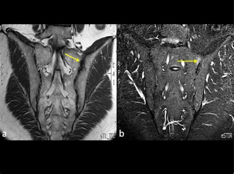 Sacroiliitis Coronal Mri In T1 A And Stir B Sequences Decreased