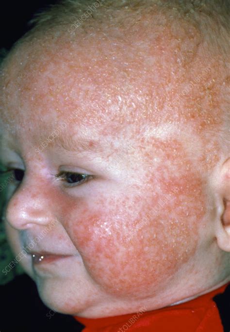 Eczema Rash On Babys Face And Head Stock Image M1500132 Science