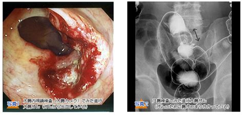 To view this video please enable javascript, and consider upgrading to a web browser that. 大腸疾患の外科治療について｜大腸がんの治療がわかる名医の ...