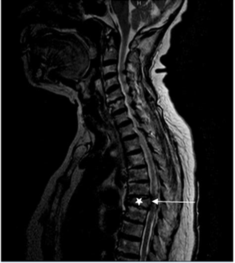 Figure 1a Mri Thoracic Spine Sagittal T2 T6 Vertebral Body Biconcave