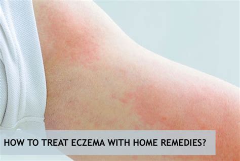 Natural Eczema Treatment What Works Best Remedygrove