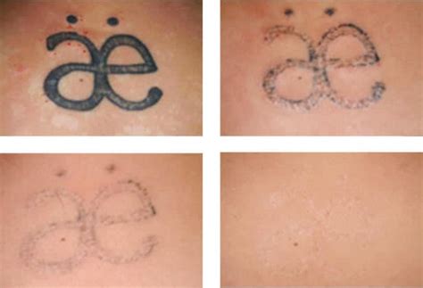Tattoo Laser Removal Scars Can Dermarolling Help Derma Roller Shop