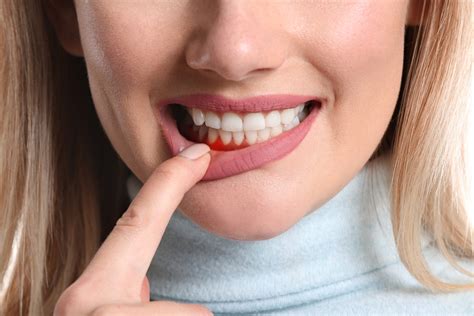 What Is Gingivitis Causes Symptoms And Treatment Thames Street