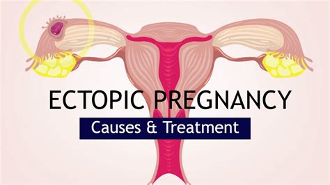 Ectopic Pregnancy Causes And Treatment Youtube