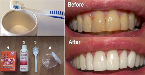 Plaque is practically invisible, so it can be very difficult to know how much is on your teeth. How To Get Rid Of Plaque And Gum Disease Without Expensive ...