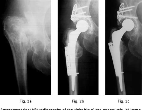 Figure 2 From Treatment Of Crowe Iv High Hip Dysplasia With Total Hip