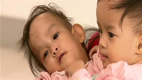 Conjoined Twins From Braidwood Successfully Separated In New York Surgery Abc7 Chicago