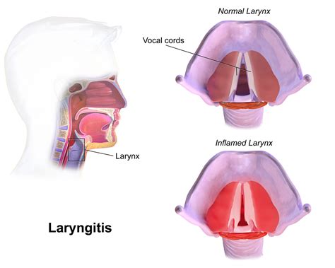 Laryngitis is inflammation of the mucous membrane of the larynx, also known as the voice box. Afonía y disfonía en niños. ¿Cuándo son preocupantes? | Faros HSJBCN