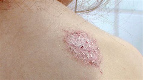 Mild Nummular Eczema