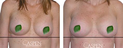 Coffee may help prevent prostate cancer, heart risk for men with breast cancer, and more cancer news. How Can You Reduce Pain and Hardness to Breast Implants ...