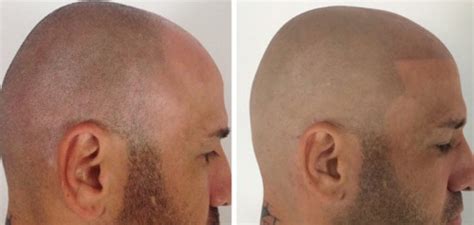 Smp hairline before and after. Micro Hair Pigmentation, Balding, Hairline Tattoo, Hair ...